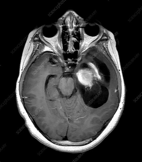 Pleomorphic Xanthoastrocytoma MR - Stock Image - C043/3134 - Science ...