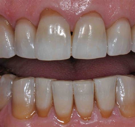 Tetracycline Stain Web - Lee Ann Brady, DMD's Dental Blog