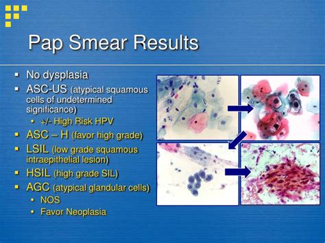 PPT - Management of Abnormal Pap Smears and Cervical Dysplasia ...