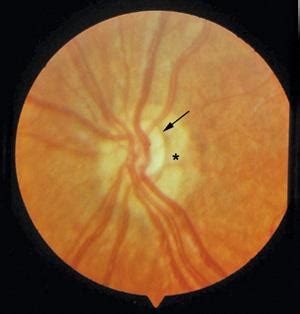 . Optic Nerve Disorders | Obgyn Key