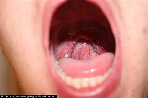 I have food particles stuck in my throat, how do I get it out? (pain ...