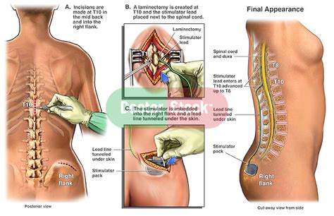 Spinal cord dorsal column stimulator - kotinor