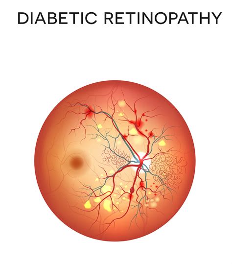 Diabetic Retinopathy Caused by Nerve Damage, According to New Study