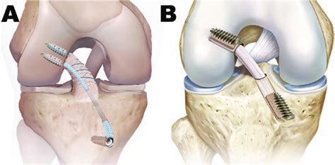 Primary ACL Repair Boston | ACL Injury | ACL Tear Waltham MA