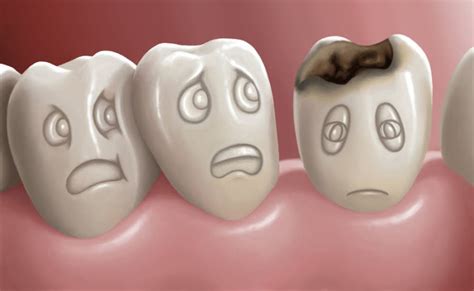 Cavity Protection Treatment to Kill Cavity - Preffered Dental Care