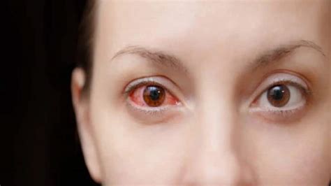 Eye Flu: Can Looking At Someone's Eyes Cause Conjunctivitis? Check ...