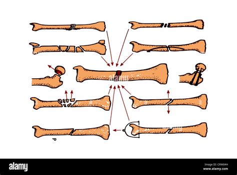 Complications of fracture healing Stock Photo - Alamy