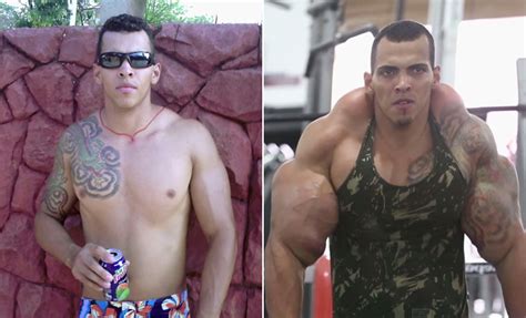 Synthol Infection