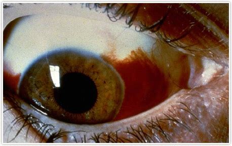 Blood in White of Eye Detroit | Subconjunctival Hemorrhage Pontiac ...