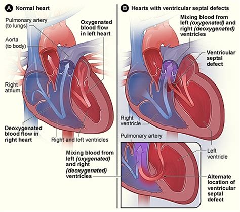 What is Congenital Heart Disease - Types, Causes, and Symptoms