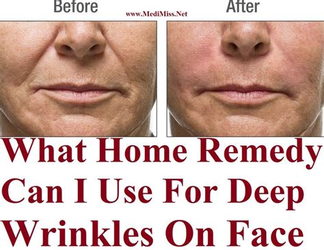 What Home Remedy Can I Use For Deep Wrinkles On Face | Face wrinkles ...