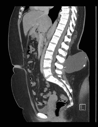 Dislodged lumboperitoneal shunt | Image | Radiopaedia.org