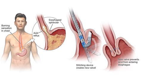 TIF- Transoral Incisionless Fundoplication - UF Health