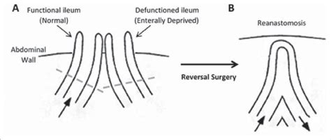 Structure of the intestine. (A) Loop ileostomy and (B) following ...