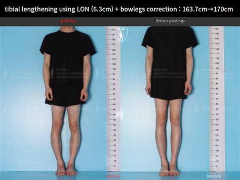 tibial lengthening using LON (6.3cm) + bowlegs correction : 163.7cm→ ...