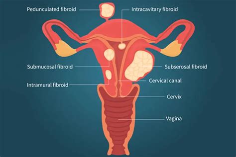 Myoma (Uterine Fibroids) - Causes, Symptoms & Signs | Gleneagles Hospital