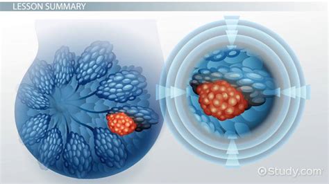 What is a Malignant Tumor? - Definition & Treatment - Lesson | Study.com