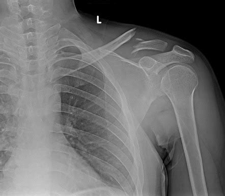 Clavicular Fracture Types