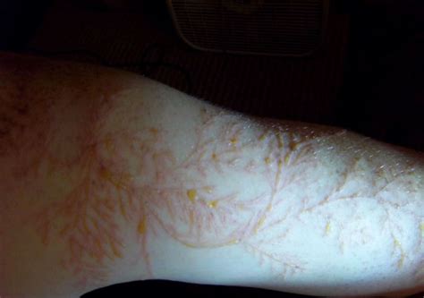 Lichtenberg Scars — Nature’s Tattoo You Don’t Want To Have | Bored Panda