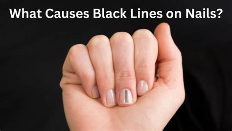 Black Lines on Nails: Causes, Symptoms, and Treatment