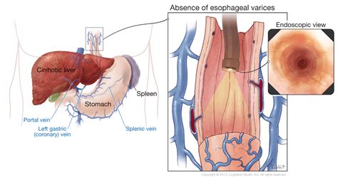 Core Concepts - Screening for Varices and Prevention of Bleeding ...