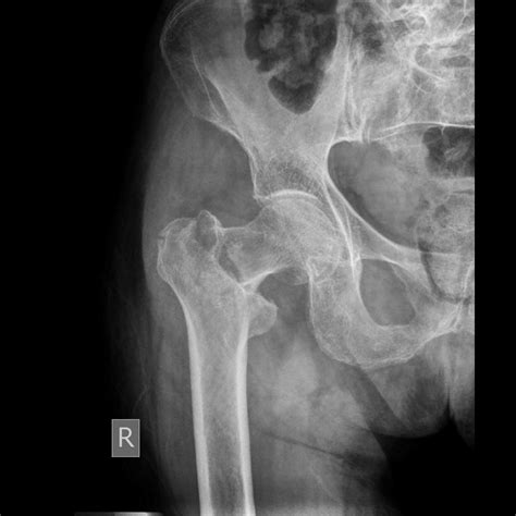 Femoral Neck Fractures – Core EM