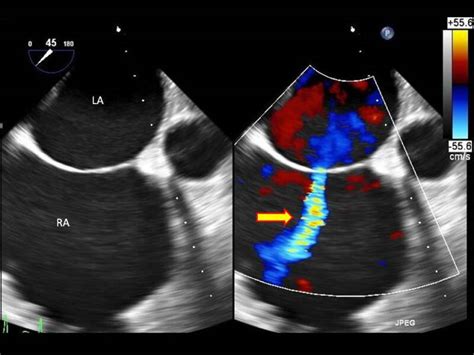 Atrial Septal Defect - StatPearls - NCBI Bookshelf