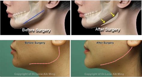 Considering jaw shaving surgery. Has anyone had this procedure ...