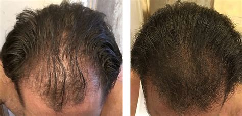 Finasteride Results: Timeline, Photos, Before & After