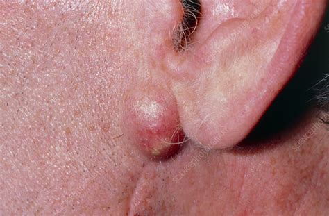 Infected sebaceous cyst on man's jaw (under ear) - Stock Image - M130 ...