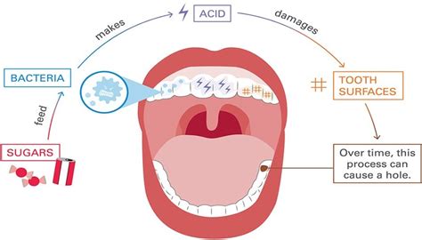 What are Dental Caries: Caused, Symptoms & Dental Caries Treatment