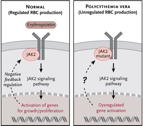 Polycythemia Vera: Causes, Symptoms & Treatments | Global Treatment ...