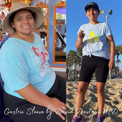 Gastric Sleeve Before and After Photos