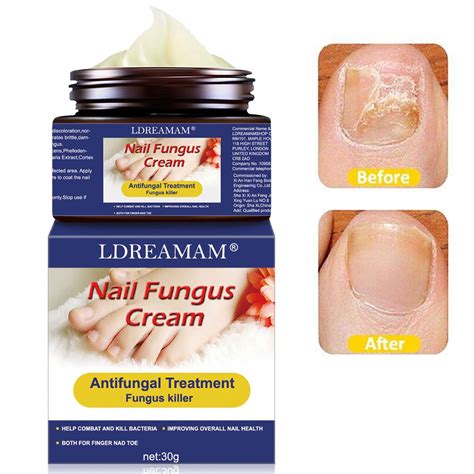 Buy Fungus Cream,Nail Fungus Cream,Foot Fungus,Fungus Stop,Anti fungal ...