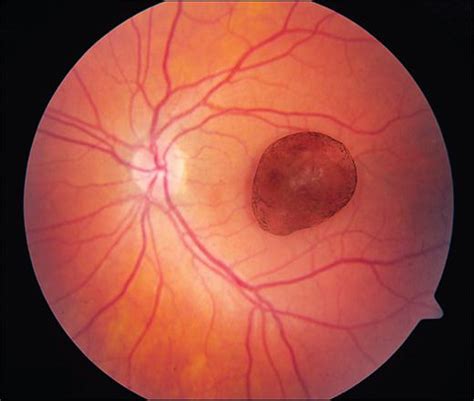 Imaging of a Pigmented Free-Floating Vitreous Cyst | JAMA Ophthalmology ...