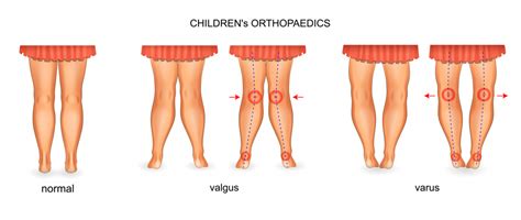 Varus vs Valgus Knee - Real Mina