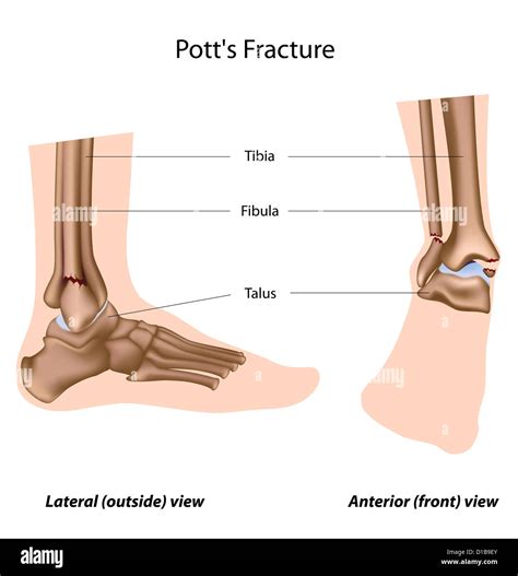 Lateral Malleolus Fracture