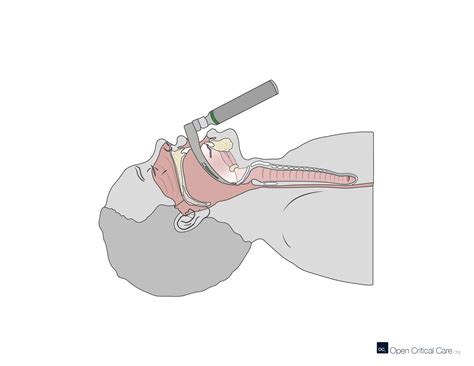 Sagittal cross section view of laryngoscopy intubation with mac 3 ...