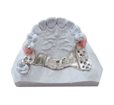 Digital Partial Denture Design: Acetal Resin, Wironium, and Titanium