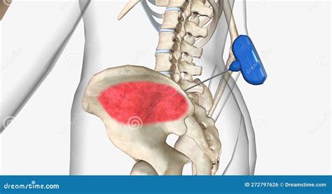 Bone Marrow Biopsy, External View Stock Illustration - Illustration of ...