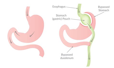 Loop Duodenal Switch (SADI-S) Surgery Cape Girardeau MO