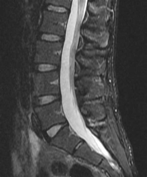 MRI Lumbar Spine (Female) - Mediphany