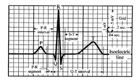 Normal ECG Tracing