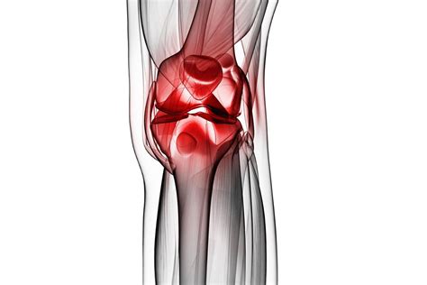 Active Synovitis Vs. Subclinical Synovitis