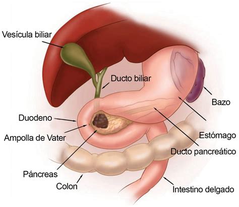 Olaparib para cáncer pancreático con mutaciones en BRCA