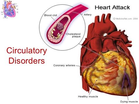 06 circulatory disorders