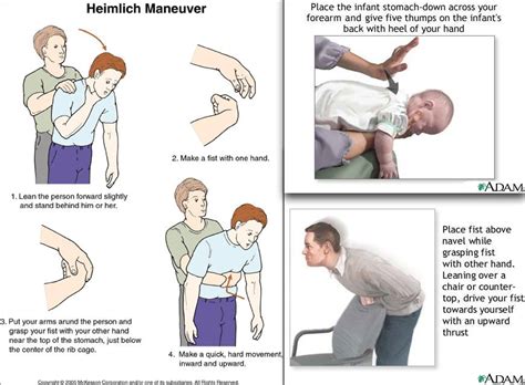 Manovra di Heimlich: Guida Alle Manovre di Disostruzione