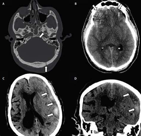 Neuroimaging Traumatic Brain Injuries - Practical Neurology