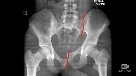 HD - Pelvic Fractures | EM:RAP