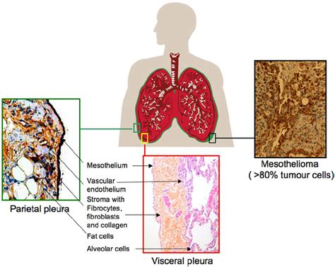 Schematic presentation of mesothelioma, the parietal and visceral ...